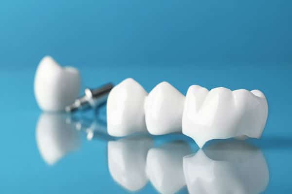 Dental implant model showing prosthetic tooth placement procedure on blue surface with reflection.