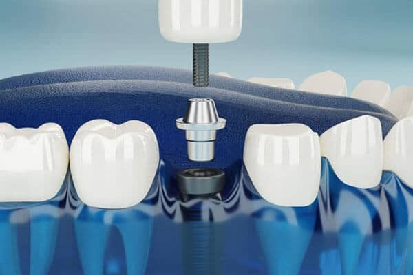 Electric toothbrush cleaning teeth with blue gum illustration and dental care focus.