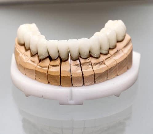 Dental prosthetic model showing ceramic teeth implants on tan jawbone replica against white background.