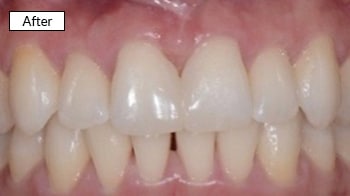 After dental treatment showing whitened, evenly aligned front teeth with improved smile aesthetics.