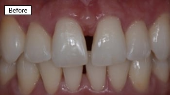 Before dental treatment: close-up of natural teeth showing discoloration and uneven appearance.