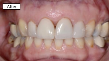 Close-up of natural-looking dental veneers on upper front teeth showing bright, even smile result.