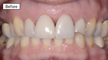Before dental treatment: close-up of natural teeth showing discoloration and spacing issues.