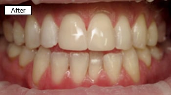 Close-up of bright, white aligned teeth showing successful dental treatment results after orthodontic care.