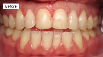Before dental treatment showing misaligned upper and lower teeth with spacing issues