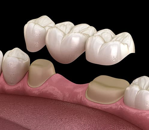 3D dental implant illustration showing tooth replacement procedure with crown restoration on gum model.