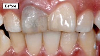 Before dental treatment showing discolored, stained upper front teeth requiring whitening restoration