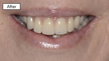 Close-up of healthy white teeth in a bright smile after dental treatment
