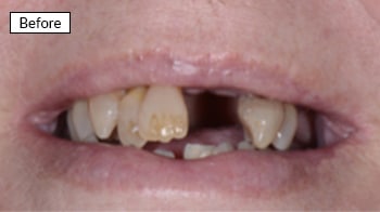 Before photo showing discolored, misaligned teeth with visible gaps and decay.