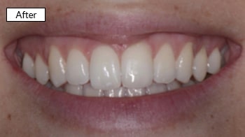 Close-up of a person's smile showing white, evenly aligned teeth after dental treatment.
