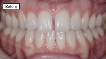 Close-up dental photograph showing before treatment teeth with spacing and alignment issues.