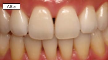 Cosmetic dental work showing whitened upper front teeth with improved alignment and brightness after treatment.