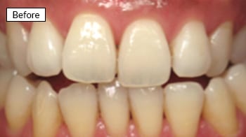 Before dental treatment: close-up of natural teeth showing discoloration and uneven appearance