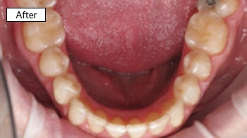 Dental after-treatment showing aligned lower teeth and improved smile in clinical setting.