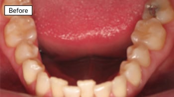 Before: Open mouth view showing lower teeth with crowding and misalignment in dental setting.