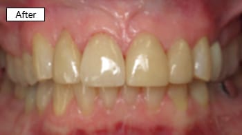 Close-up of upper front teeth showing dental work results, labeled "After" treatment.