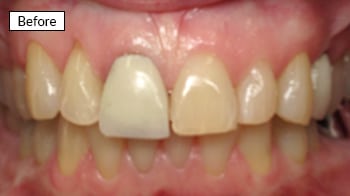 Before dental treatment: discolored and uneven front teeth requiring cosmetic dental work