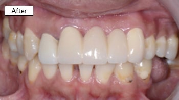 Close-up of healthy, aligned upper and lower teeth after dental treatment, labeled "After"