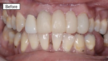 Before dental treatment: close-up of patient's teeth showing discoloration and uneven alignment